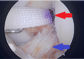 The Artelon Flexband Graft (red arrow) is used to strengthen and protect the ACL (blue arrow)