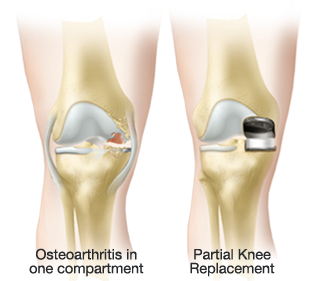 Partial knee replacement resurfaces only the damaged compartment of the knee while preserving the remaining healthy anatomy