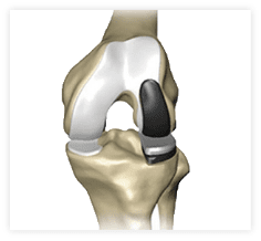 A unicompartmental partial knee replacement may be used when only one compartment area of the joint is damaged