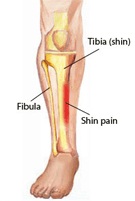 Shin Splints