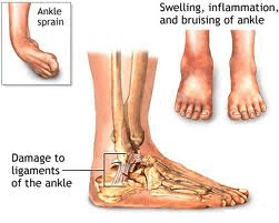 Sprained Ankle