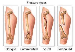 Types of Fractures