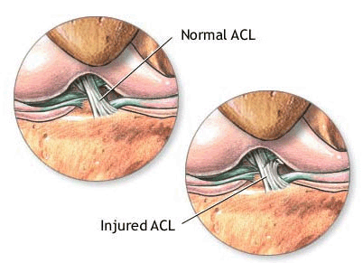 acl tear symptoms