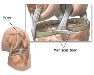 Meniscus Tear