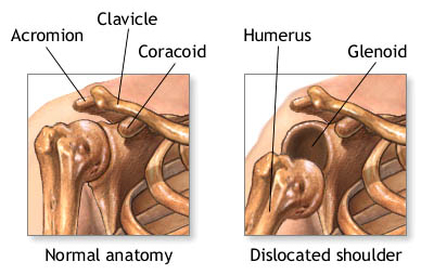 Dislocated Shoulder