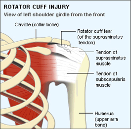 Rotator Cuff Tear