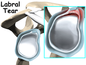 Shoulder Labrum Tear