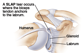 Slap Tear